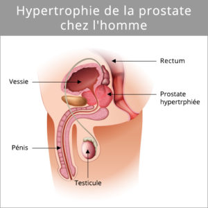 prostaze-hypertrophie-de-la-prostate-specialhomme.com